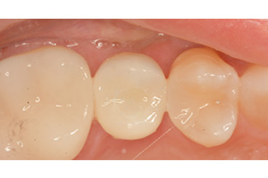 CEREC Dentist Burton MI