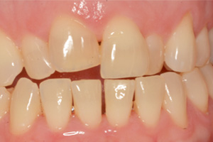 CEREC Dentist Burton MI
