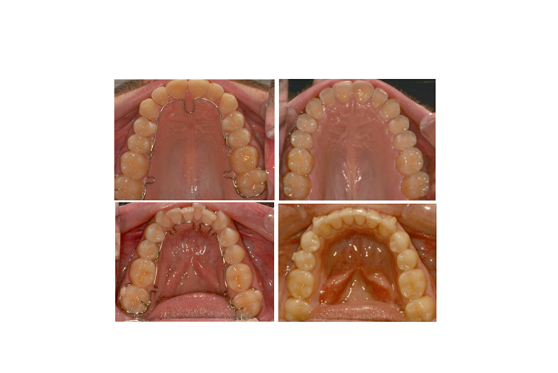 Park Dental Wellness | CO    Laser QuietNite  , Dexis Digital Radiography and Extractions